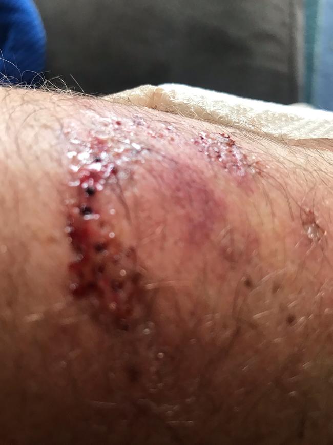 A close-up of the bite wound. Picture: POLICE ASSOCIATION OF TASMANIA