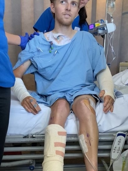 Aspiring cycling star, James Hand speaks of a horrific road accident which left him with four broken limbs and requiring over 20 hours of surgery.