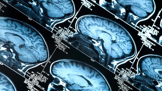 The NT’s only neurologist will move interstate next month. PICTURE: Thinkstock