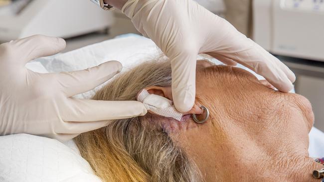 Patient Melissa Darnley after specialist dermatologist Dr Andrew Freeman removed a skin cancer from her ear. Picture: Jerad Williams