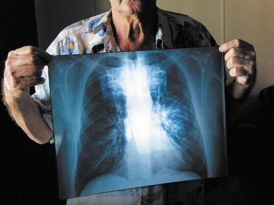 BLACK LUNG: Percy Verrall was diagnosed with black lung disease in 2015. He was the first Australian diagnosed with the disease in 30 years.