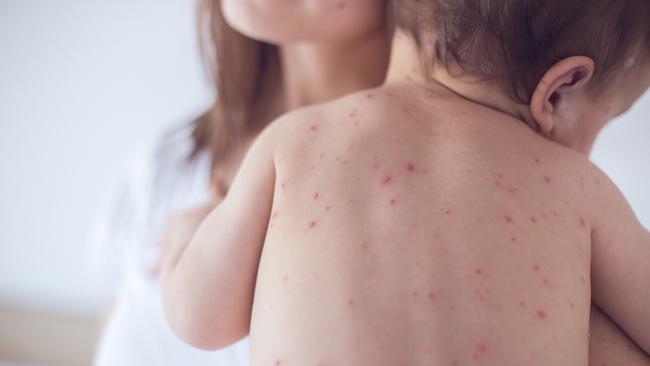 measles-brisbane-alert-issued-after-child-is-diagnosed-after-flight