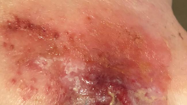 Gabrielle Collins Buruli ulcer. Picture: Tony Gough