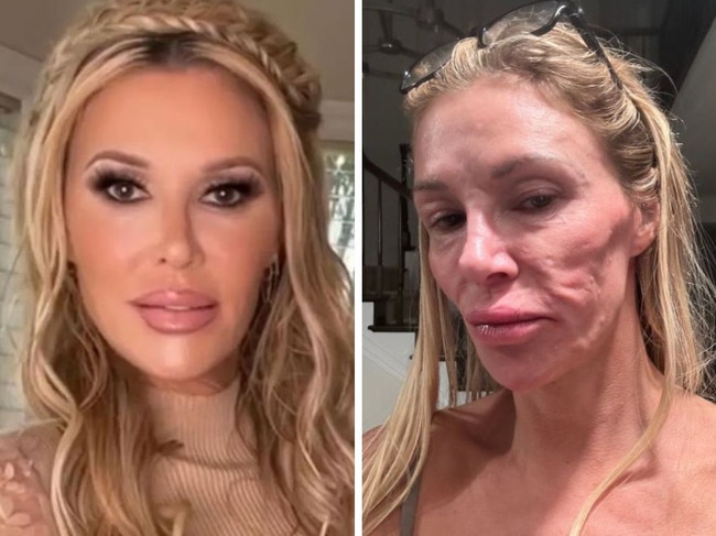 Brandi Glanville reveals facial disfuregment.