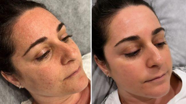 Before a cosmelan peel (left) and 1 month post peel (right). Images: Leah Goulis