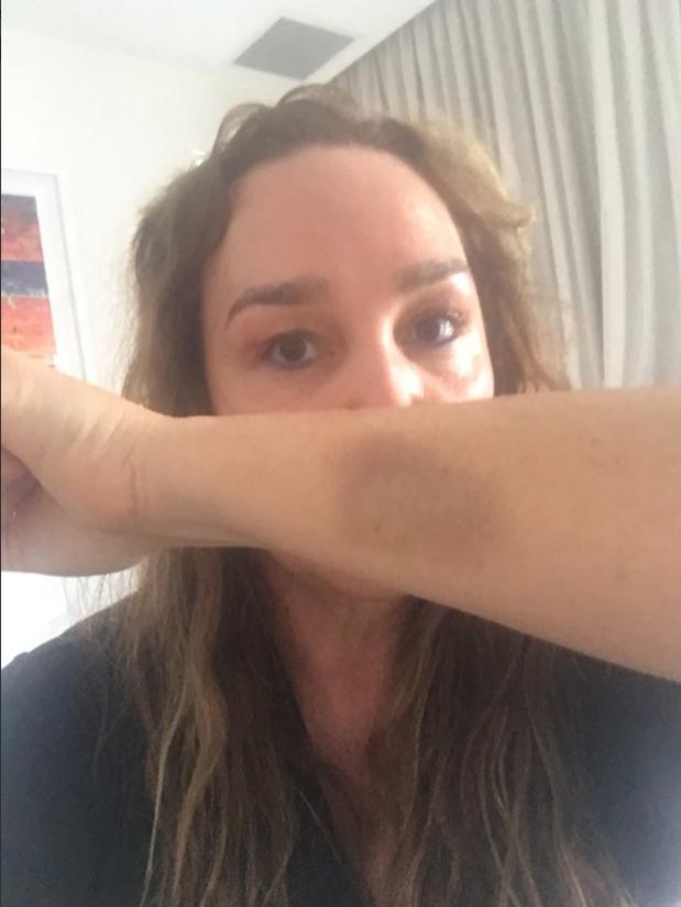 Kate Langbroek was bruised after she was attacked at her St Kilda home on March 2.