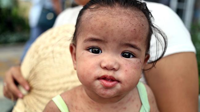 A child with the measles in the Philippines, which is suffering a serious outbreak of the disease. Picture: Alejandro Ernesto/dpa