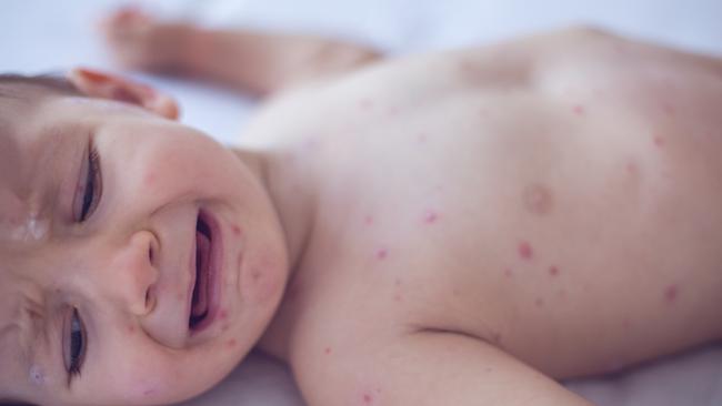 A typical measles rash. Picture: File / iStock