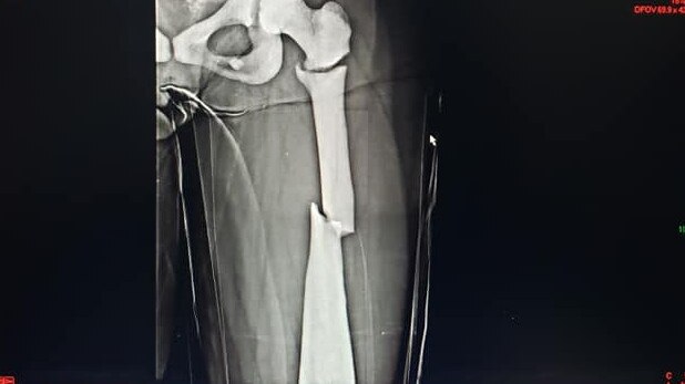 An X-ray of Alicia’s leg showing the damage to her femur. Source: Facebook