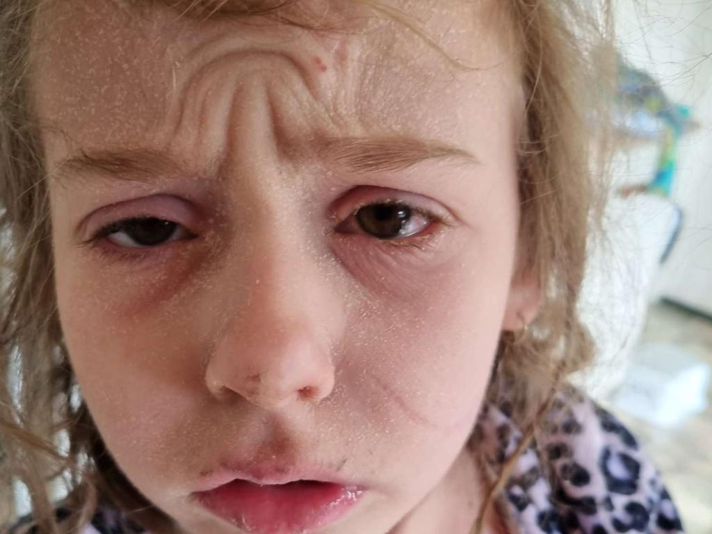 Eight Year Old Girl Battles Severe Eczema Flare Up The Australian 