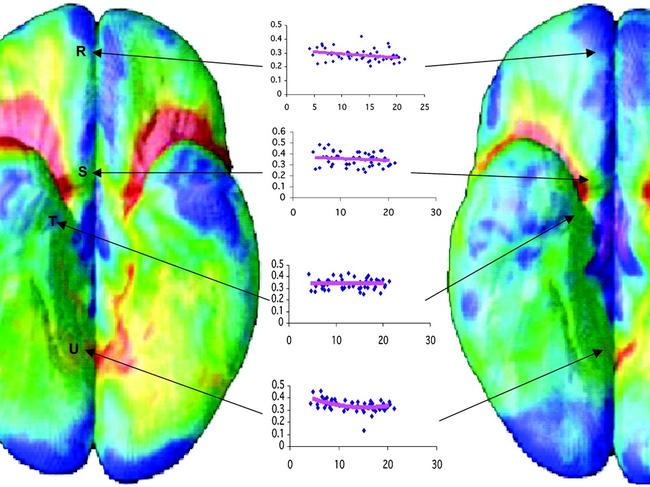 Bottom view of the brain showing early and late time-lapse images. Picture: Supplied/ PNAS