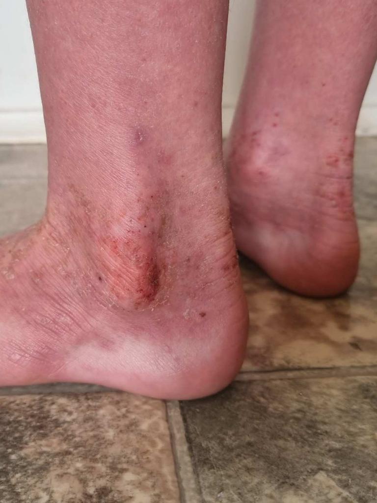 The eczema on Mia's ankles. Picture: Supplied