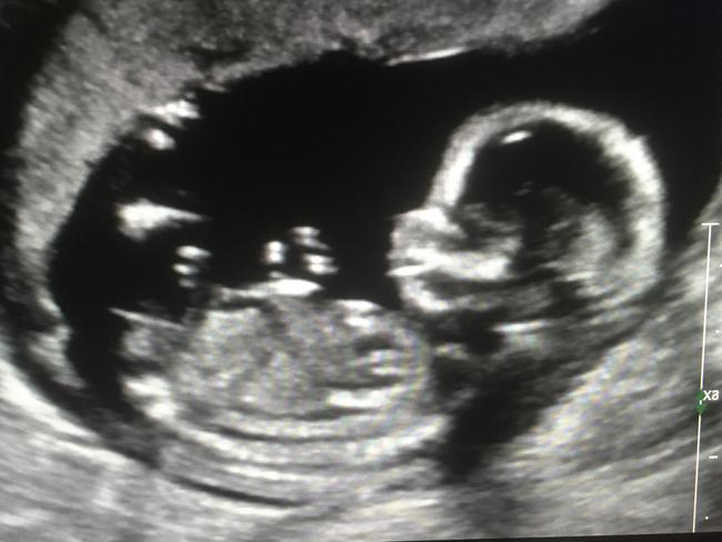 An ultrasound of baby Hannah. Picture: Nowra Radiology