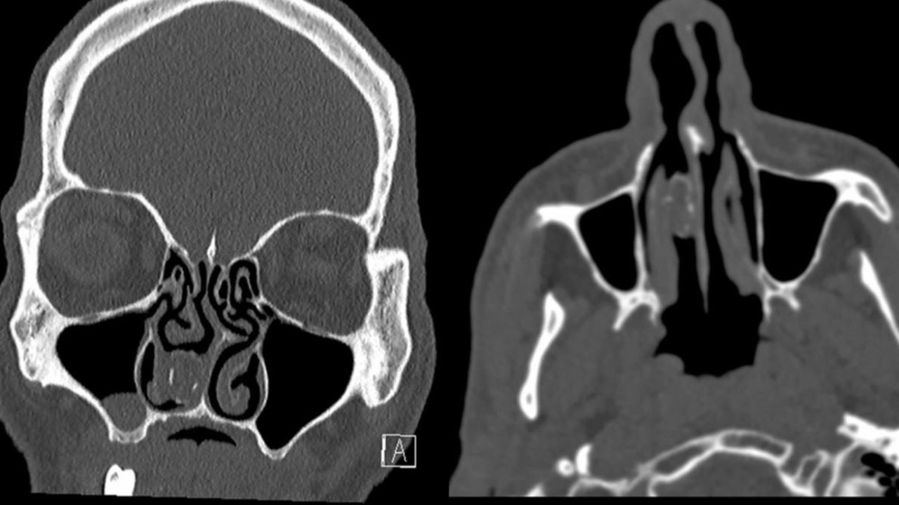 The scan revealed something was lodged in his nasal cavity. Picture: British Medical Journal