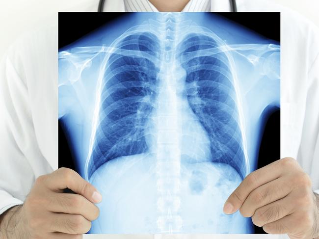 The CSIRO has used AI to create a system that detects heart and lung conditions from X-ray images. Picture: Lung Foundation Australia