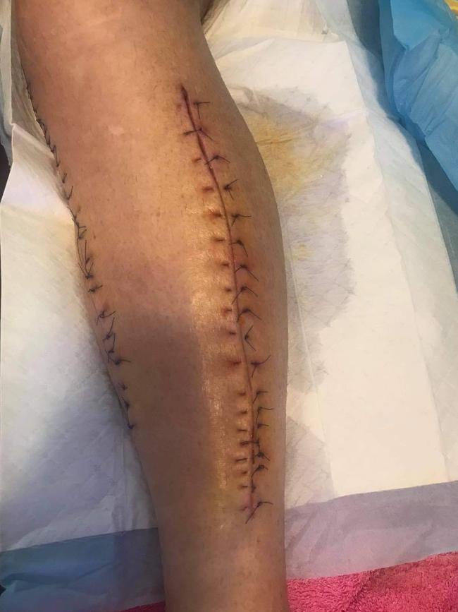 Albert Schneider has scars running from his knee to his ankle after developing multiple blood clots from the AstraZeneca vaccine. Picture: Supplied