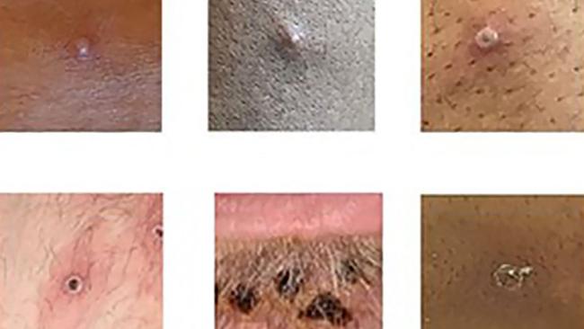 A collage of monkeypox rash lesions. Picture: Handout / UK Health Security Agency / AFP