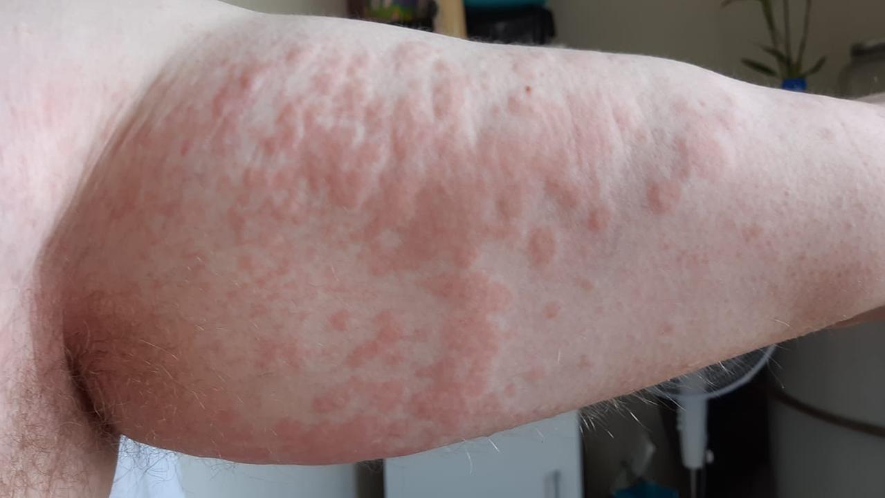 Lara rash residents developing hive like skin irritation