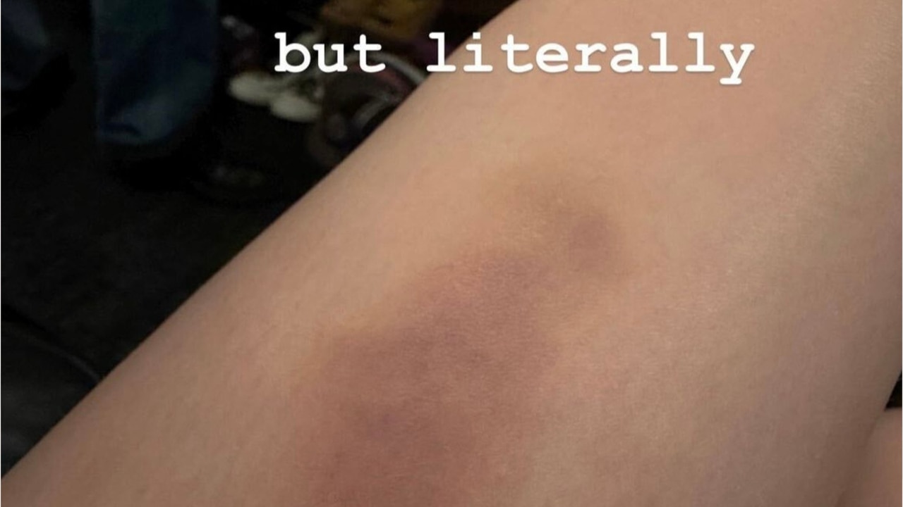 Billie Eilish displays large bruise after falling over at concert