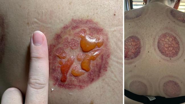 A woman has been left with oozing wounds after a cupping experience at Logan Hyperdome.