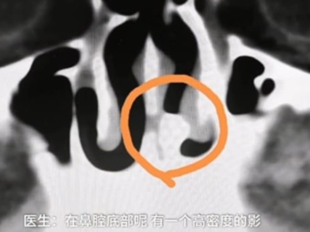 Doctors found a suspicious shadow in the man’s nasal passage. Picture: Supplied / Pear Video