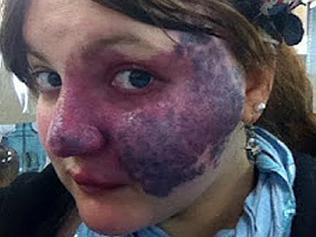 BIRTHMARK GIRL IS VIRAL MEME