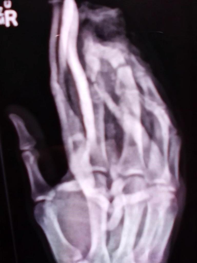 X-ray of Jay Mobbs injured hand that was crushed by a log splitter in a workplace incident.