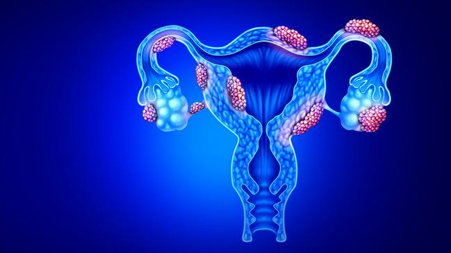 Endometriosis disease has a huge impact on quality of life. Picture: iStock