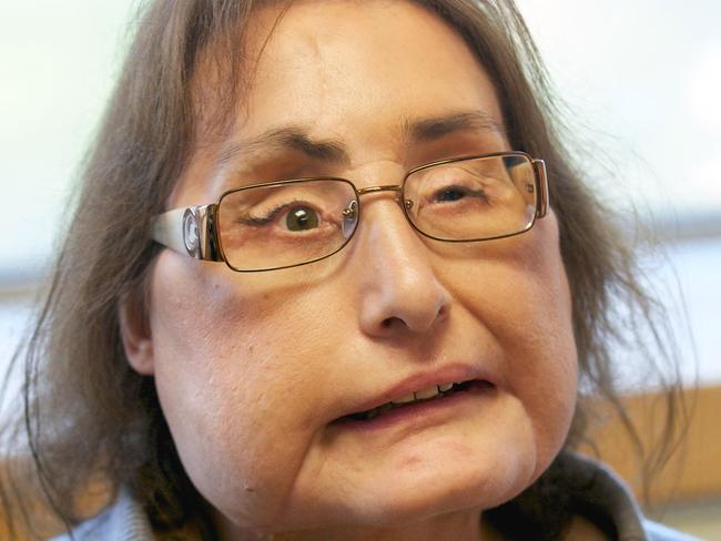 Connie Culp, who underwent the first face transplant surgery in the U.S. talks with the Associated Press at the Cleveland Clinic on Tuesday, Sept. 14, 2010 in Cleveland. The woman who had the nation's first face transplant is asking Ohioans to register as organ donors. (AP Photo/Jason Miller)