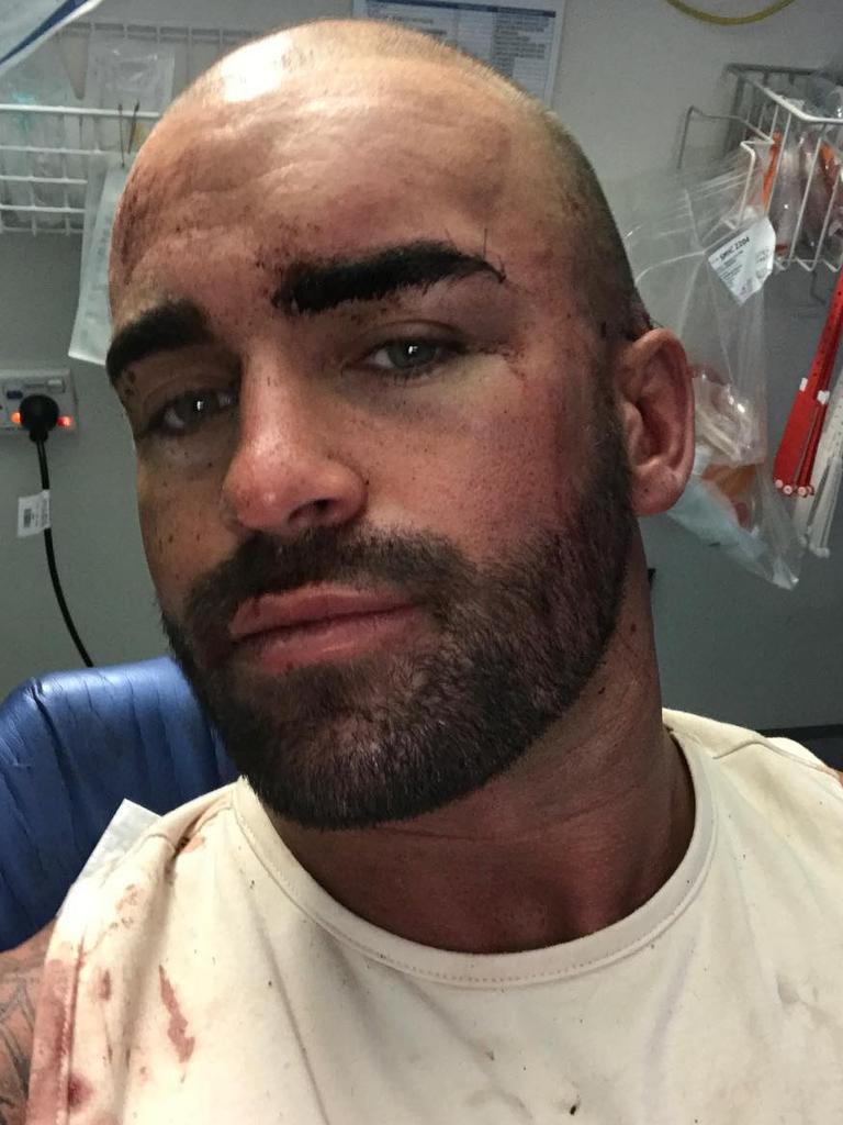 Mr Chadwick posted a photo of his injuries after the brawl. Picture: Instagram