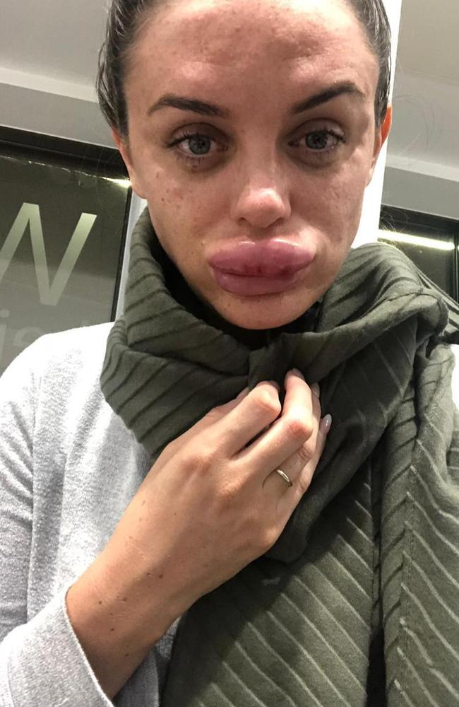 400 Botox Party Leaves Woman In Agony With Swollen Lips The Advertiser 