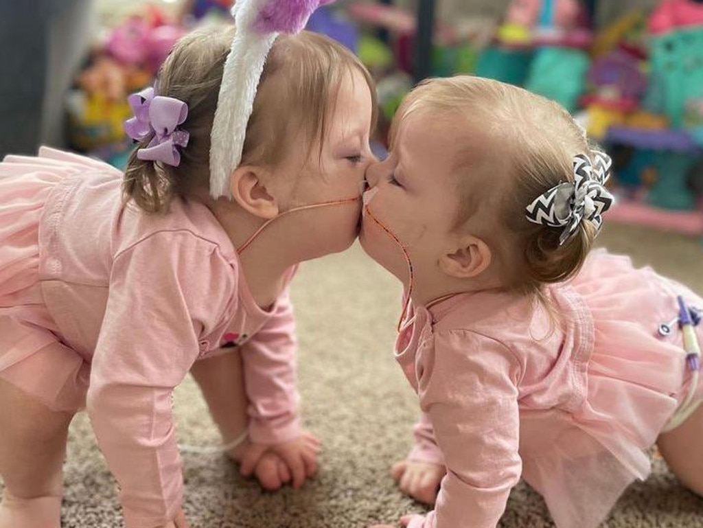 Michigan Conjoined Twins Sarabeth And Amelia Thrive After Separation