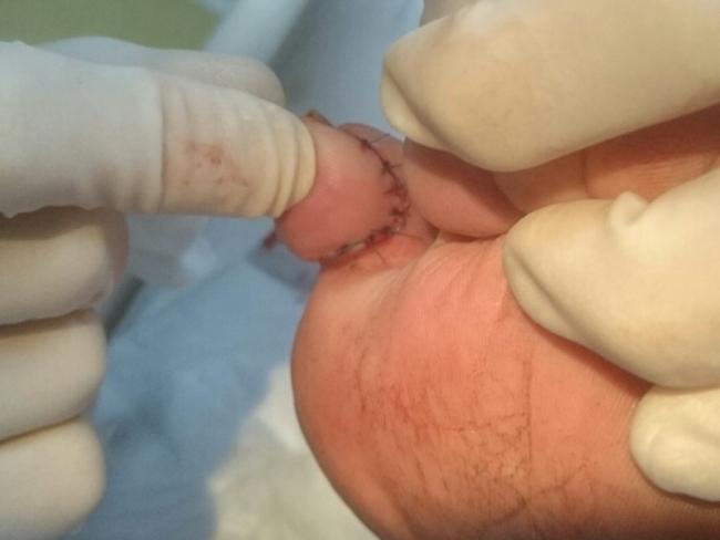 Mr Ahearn’s toe after eight stitches were inserted at Corryong Hospital. Picture: Supplied