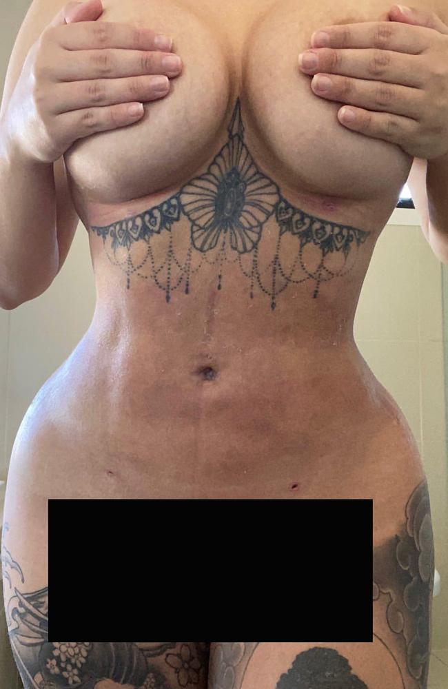 Renee Gracie’s body after the BBL surgery six weeks ago.