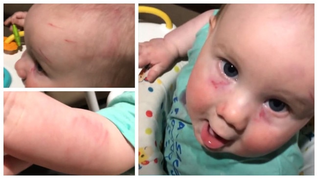 A Brisbane family claims their baby was injured by an older child at daycare.