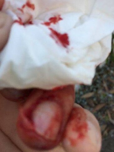 The result of a dog attack on an Ergon Energy worker in Queensland.