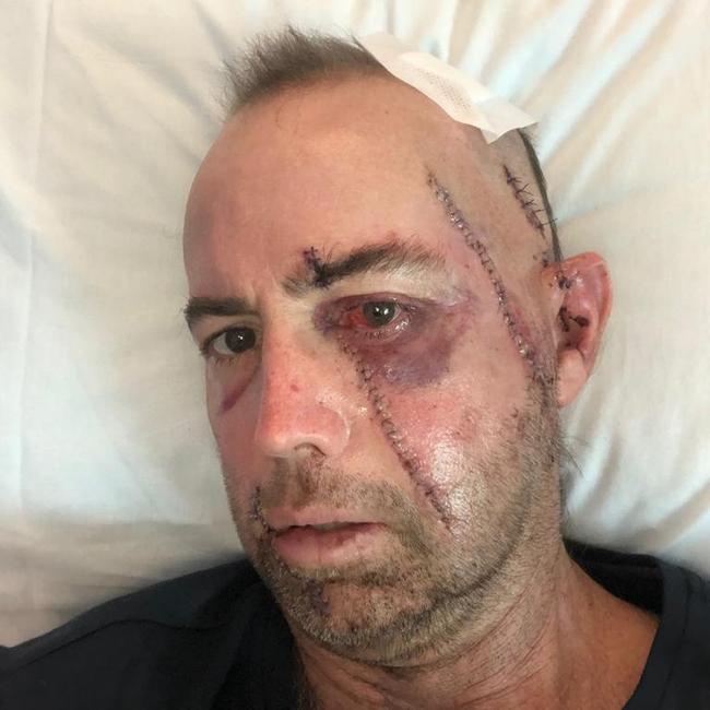 The Gold Coast father said he had one hell of a recovery ahead of him after he was struck in the face by a boat propeller.