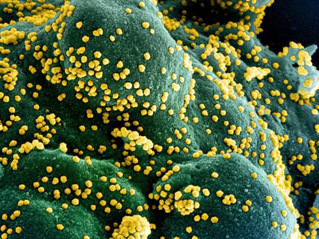 (FILES) In this undated handout image obtained July 15, 2020, courtesy of National Institute of Allergy and Infectious Diseases(NIH/NIAID), shows a colorized scanning electron micrograph of an apoptotic cell (blue/green) heavily infected with SARS-COV-2 virus particles (yellow), isolated from a patient sample, captured at the NIAID Integrated Research Facility (IRF) in Fort Detrick, Maryland. - US pharmaceutical company Eli Lilly's combination of two synthetic antibodies against Covid-19 reduced hospitalizations and deaths by 70 percent in high-risk patients with recent positive tests, the company said on January 26, 2021. "Bamlanivimab and etesevimab together have the potential to be an important treatment that significantly reduces hospitalizations and death in high-risk COVID-19 patients," Lilly's chief scientific officer Daniel Skovronsky said. (Photo by Handout / National Institute of Allergy and Infectious Diseases / AFP) / RESTRICTED TO EDITORIAL USE - MANDATORY CREDIT "AFP PHOTO /NATIONAL INSTITUTE OF ALLERGY AND INFECTIOUS DISEASES/HANDOUT " - NO MARKETING - NO ADVERTISING CAMPAIGNS - DISTRIBUTED AS A SERVICE TO CLIENTS