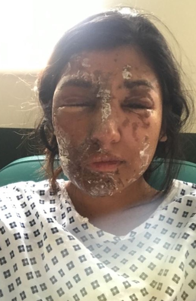 Resham Khan has told of a terrifying acid attack on her 21st birthday that left her hospitalised and her cousin in a coma. Picture: GoFund Me