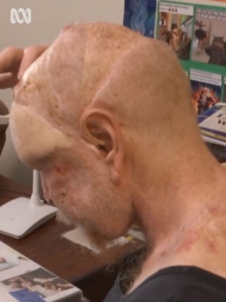 The Victorian has had almost 200 skin cancers removed. Picture: ABC