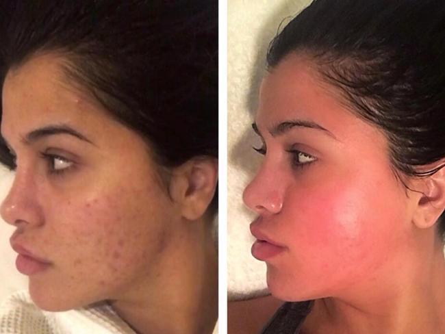 Sanaa Mehajer has battled skin problems since puberty.