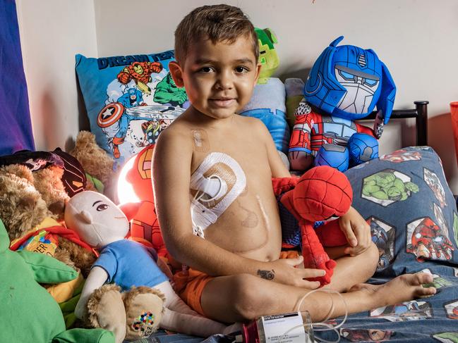 Six-year-old Mateoh Eggleton has fresh hope of a lifesaving transplant. Picture: Nigel Hallett