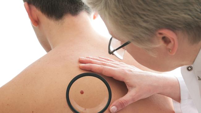 A new blood test is being developed to detect skin cancer rather than using the traditional method of doctors checking a patient for suspect skin spots.