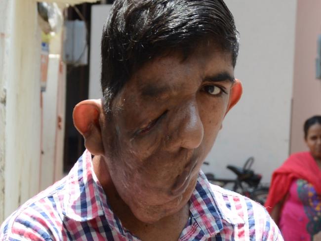 Picture: Caters ONLINE USE ONLY PIC BY CATERS NEWS -16-year-old Bhupinder Singh with a melting face has refused to live a life of a recluse rather become an inspiring icon for his kinds. Bhupinder, from Chandigarh in Punjab in northern India, is defying odds and enjoys a game of cricket every evening with friends in the neighbourhood. Despite being shunned from school because of his unusual appearance, he makes sure to read books, particularly in his favourite language English, every day. The hobby proves to be truly excruciating for him as he is blind from right eye. SEE CATERS COPY