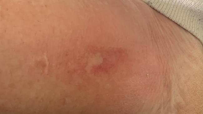 Anne Hunt's ulcer earlier on. Picture: Supplied