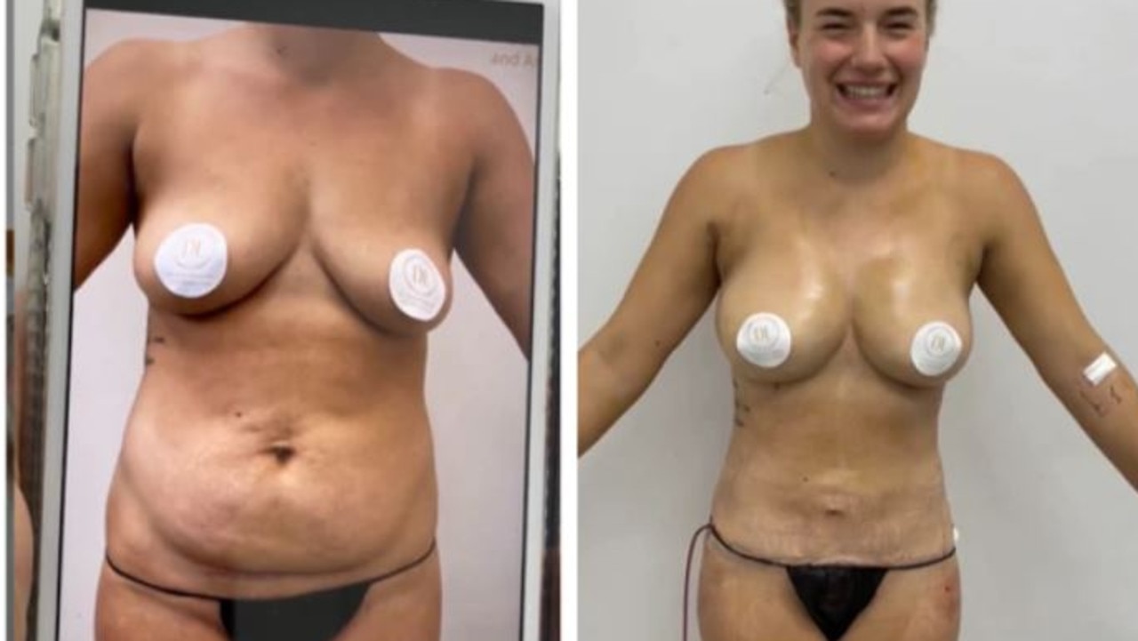 She shared her surgery progress with followers. Picture: Instagram/HouseofWhite