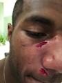 Vunivalu bears the scars of the incident.