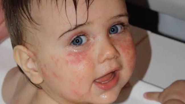 Mum creates eczema homecure Itchy Baby Co | Daily Telegraph