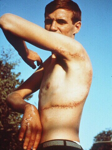 Rodney Fox shark attack victim shows his scars in 1963