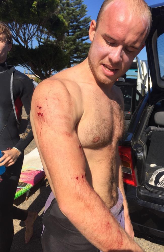 Charlie Fry, a British doctor, shows off his injury after being bitten by a shark off the NSW Central Coast. Picture: Supplied